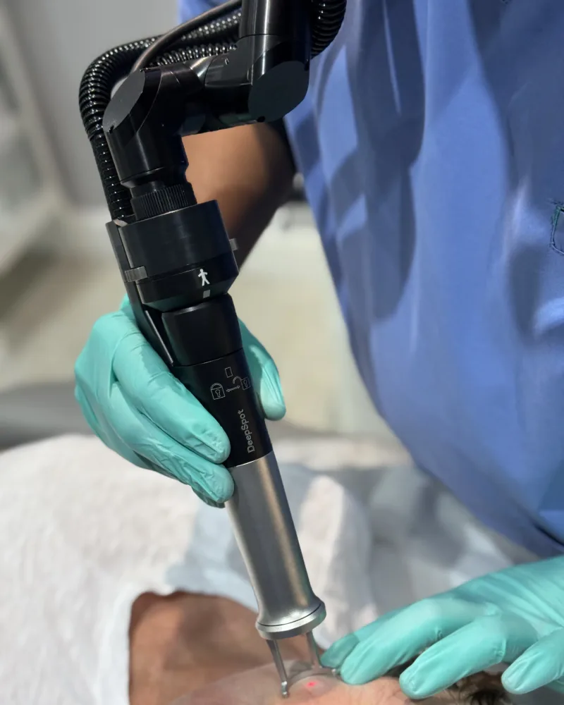 Clinician performing laser scar treatment at Rejuvena Laser & Aesthetic Clinic, Bedford