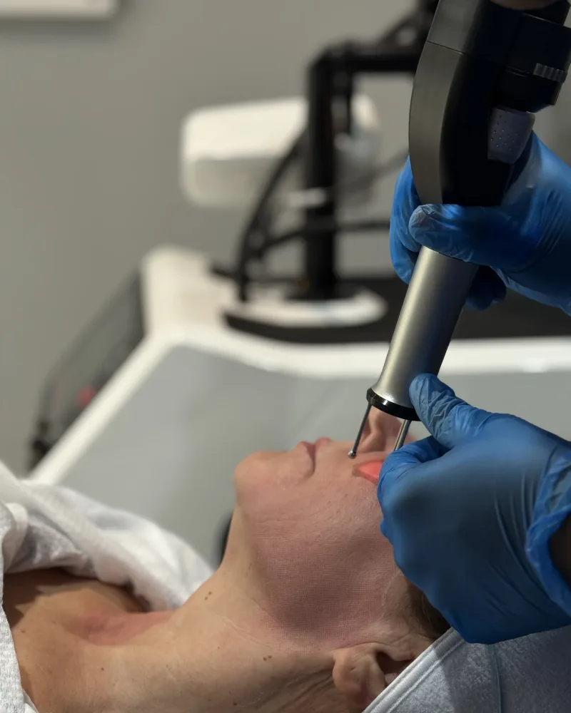 Vascular laser handpiece treating a lip-area lesion at Rejuvena Clinic, Bedford