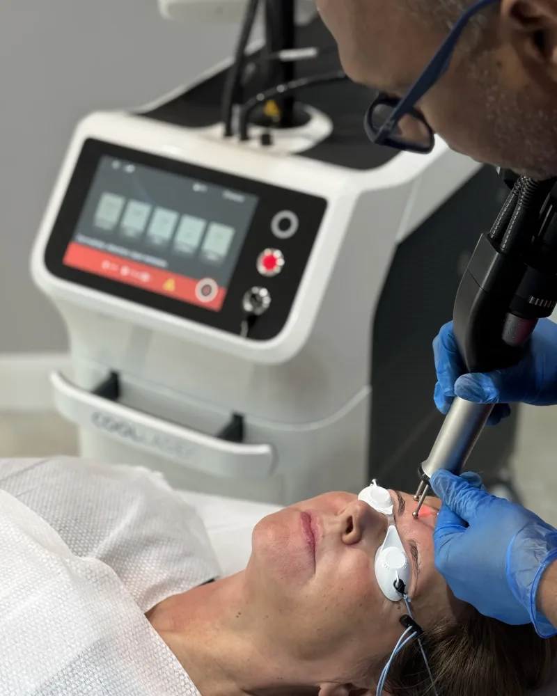 Dr Nick performing Cool Laser scar-revision resurfacing on a patient wearing protective eyewear at Rejuvena Clinic, Bedford