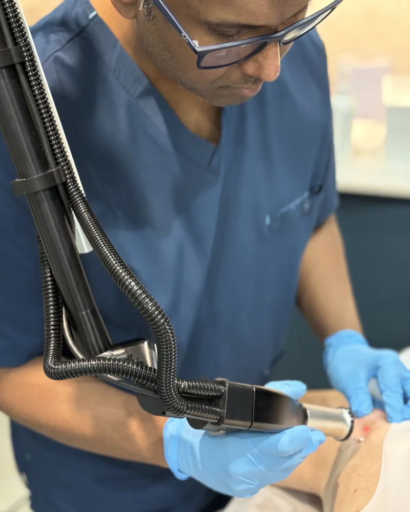 Doctor-led laser lesion and mole removal using a precision laser handpiece at Rejuvena Clinic, Bedford