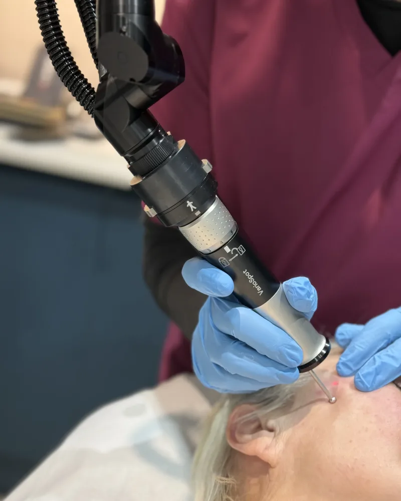 Precise laser lesion treatment close to the eye area at Rejuvena Clinic, Bedford — the same careful, doctor-led technique used for syringoma removal