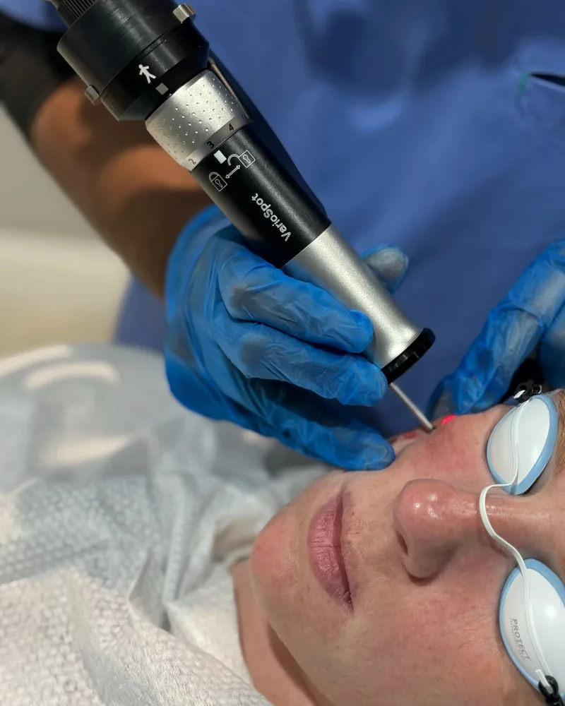 Clinician assessing a small bright-red cherry angioma (Campbell de Morgan spot) with a dermatoscope during doctor-led care at Rejuvena Clinic, Bedford