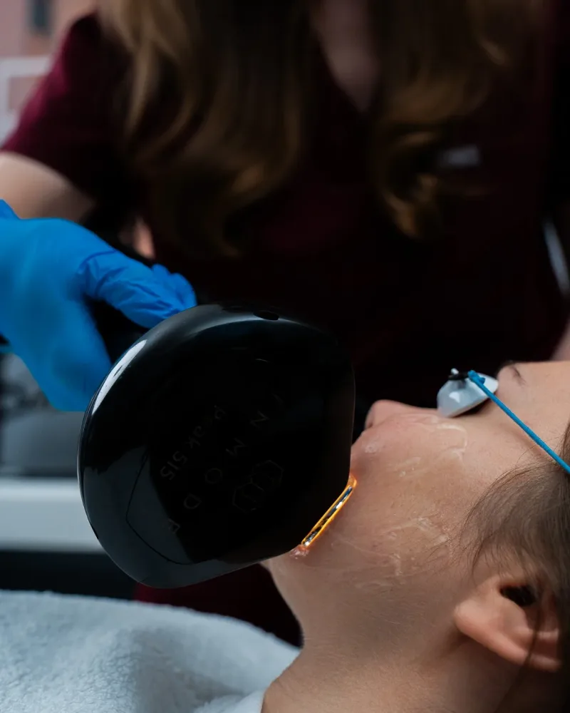 Clinician performing IPL treatment on a patient's face during doctor-led rosacea care at Rejuvena Clinic, Bedford