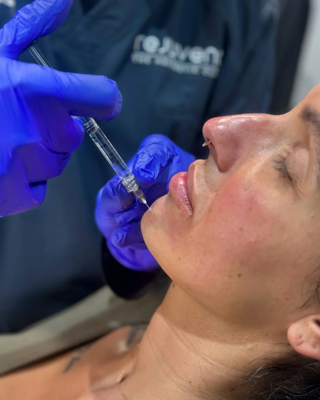 Dermal Fillers at Rejuvena Bedford