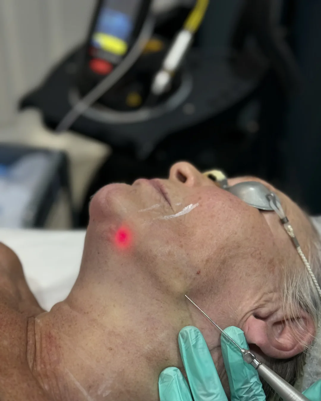 Skin Firming at Rejuvena Bedford