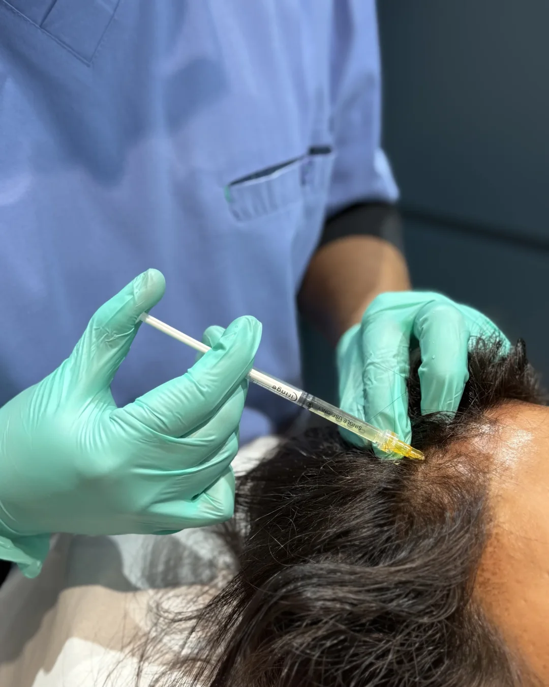 PRP / PRF Hair at Rejuvena Bedford