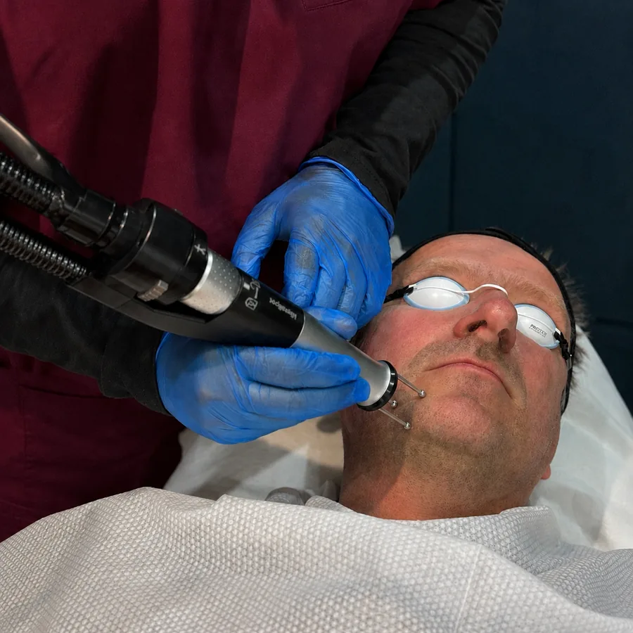 Cool Laser facial resurfacing being carried out on a male patient at Rejuvena Clinic, Bedford
