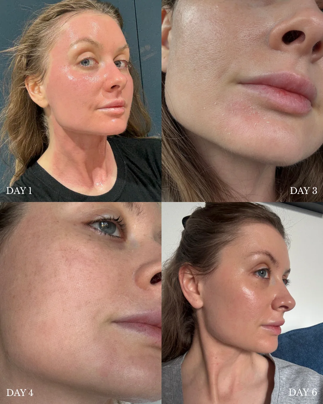 Supplied Cool Laser recovery diary showing facial skin on days 1, 3, 4 and 6 after treatment