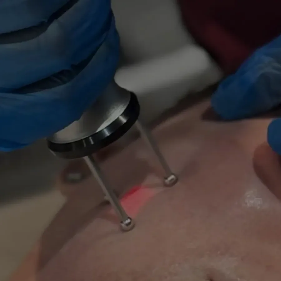 CoolGlow Baby laser resurfacing handpiece delivering a gentle pass over the forehead at Rejuvena Clinic in Bedford