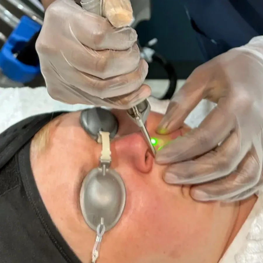 Laser skin lesion removal being carried out on the nose with protective eye shields at Rejuvena Clinic in Bedford
