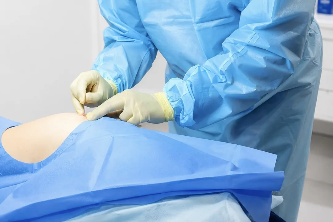 Dr Nick collecting adipose tissue from a draped donor site under sterile conditions during a SEFFILLER nano fat transfer at Rejuvena Clinic in Bedford