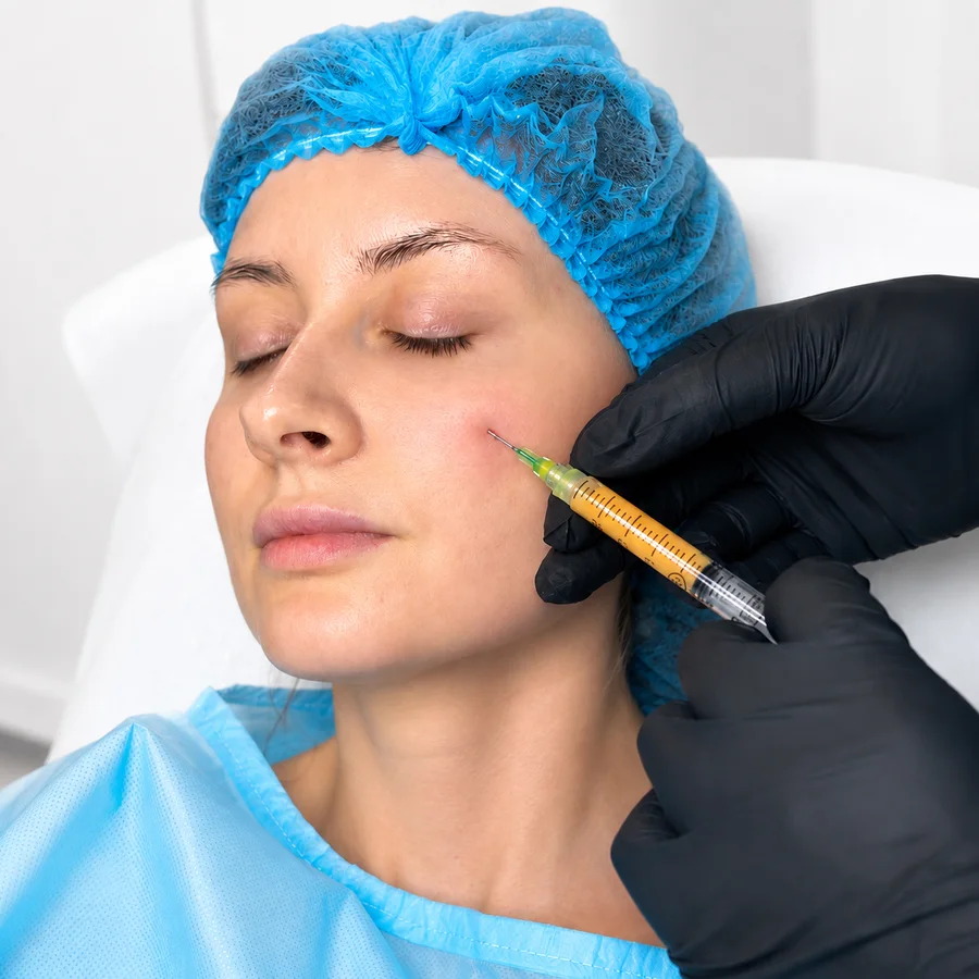 Prepared adipose tissue being transferred to the cheek during nano fat transfer at Rejuvena Clinic in Bedford