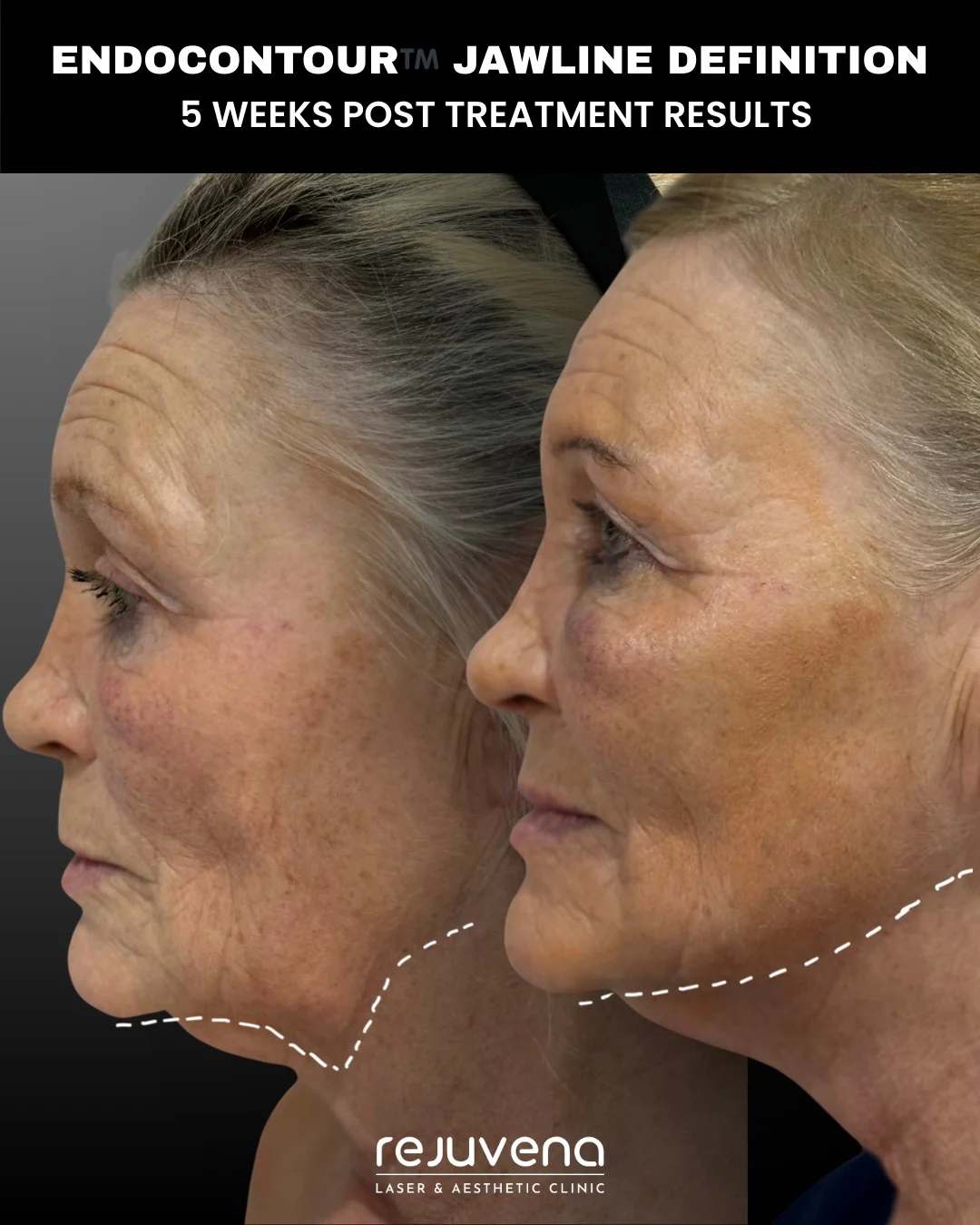 Before and after EndoContour K-Laser Blue treatment of the jawline, side profile, five weeks after treatment, Rejuvena Clinic Bedford (patient example 1)