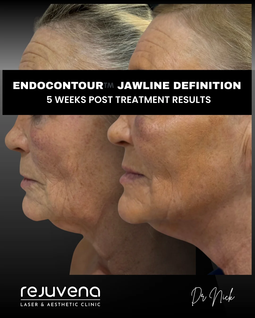Before and after EndoContour K-Laser Blue treatment of the jawline, side profile, five weeks after treatment, Rejuvena Clinic Bedford (patient example 2)
