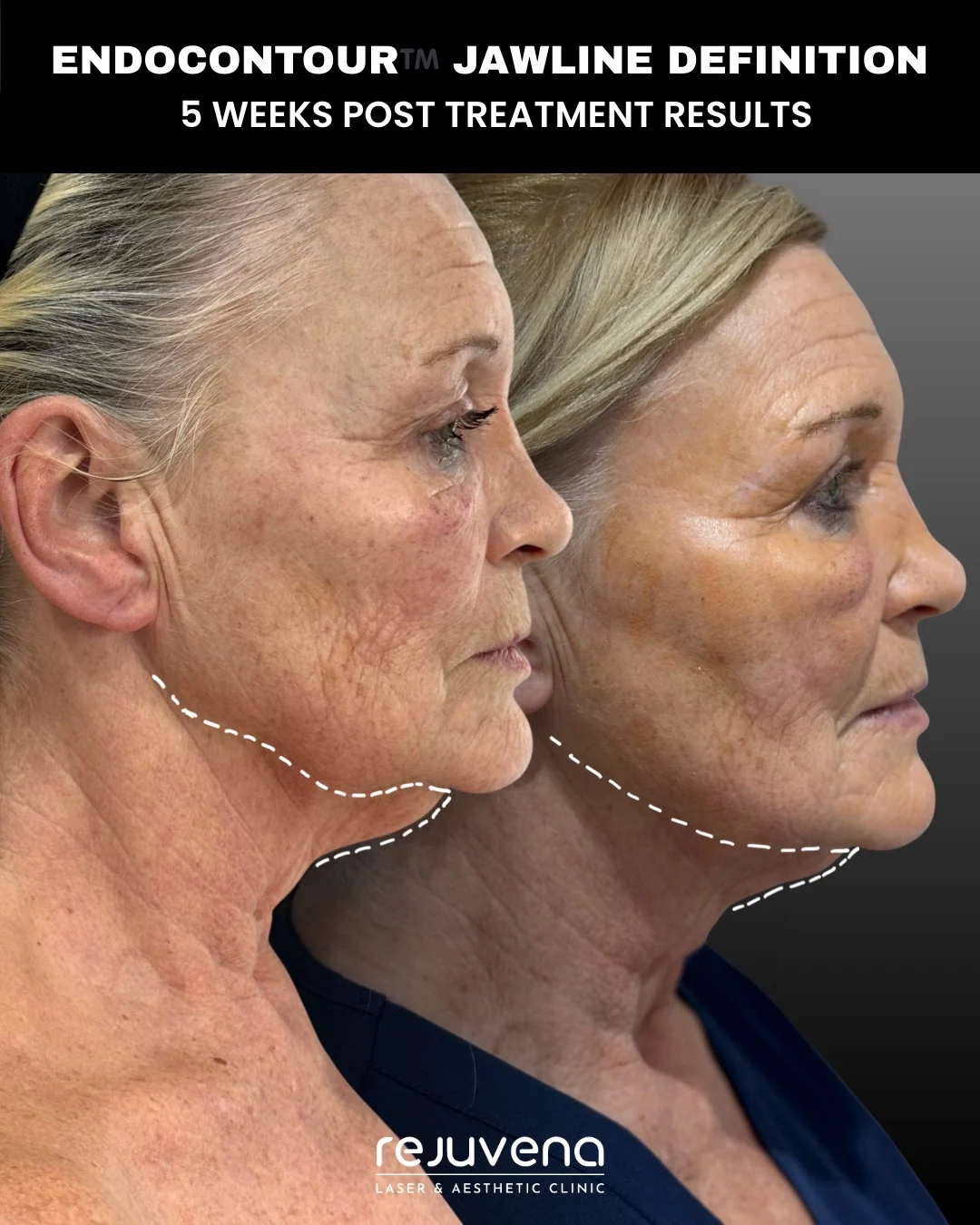 Before and after EndoContour K-Laser Blue treatment of the jawline, side profile, five weeks after treatment, Rejuvena Clinic Bedford (patient example 3)