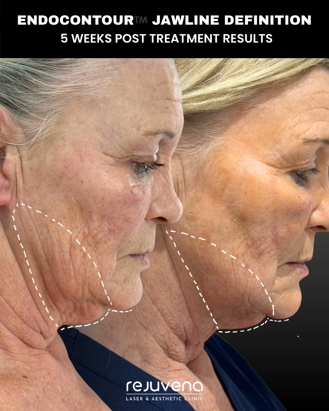 Before and after EndoContour K-Laser Blue treatment of the jawline, side profile, five weeks after treatment, Rejuvena Clinic Bedford (patient example 4)