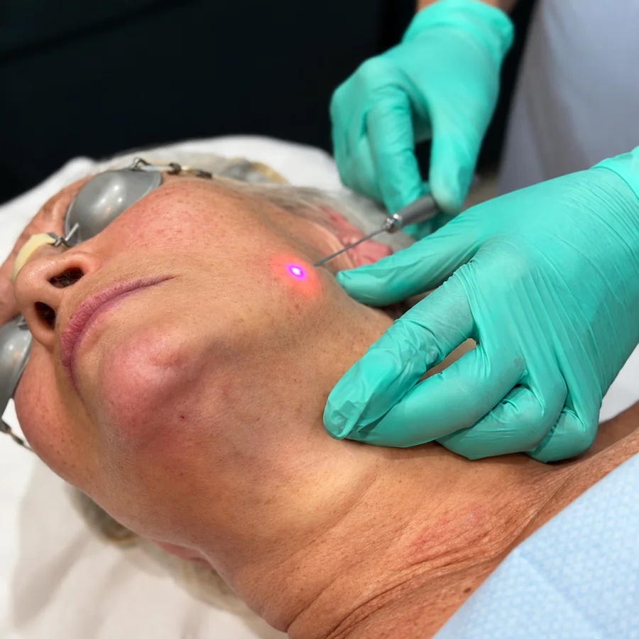 A fine optical fibre being guided beneath the skin along the jawline during an EndoContour K-Laser Blue procedure at Rejuvena Clinic in Bedford