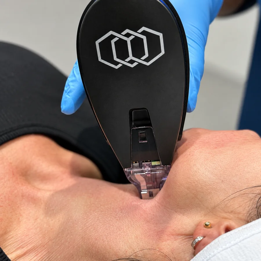 The Morpheus8 Burst RF microneedling handpiece being applied to a patient’s neck at Rejuvena Clinic, Bedford