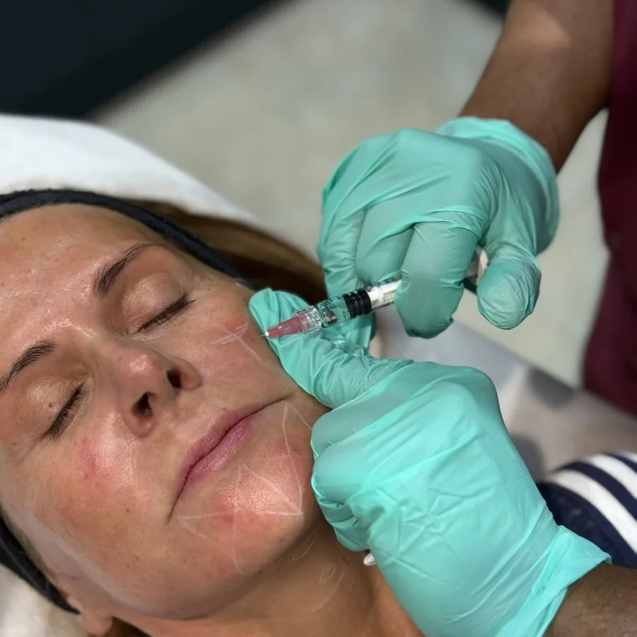 Profhilo bio-remodelling injection being placed on a patient’s cheek at Rejuvena Clinic in Bedford