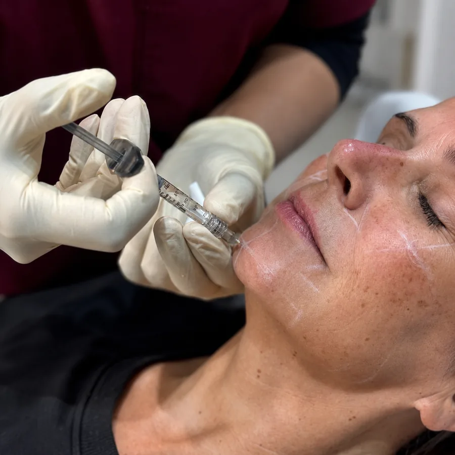 Dermal filler being injected into a patient’s cheek with a fine needle at Rejuvena Clinic in Bedford