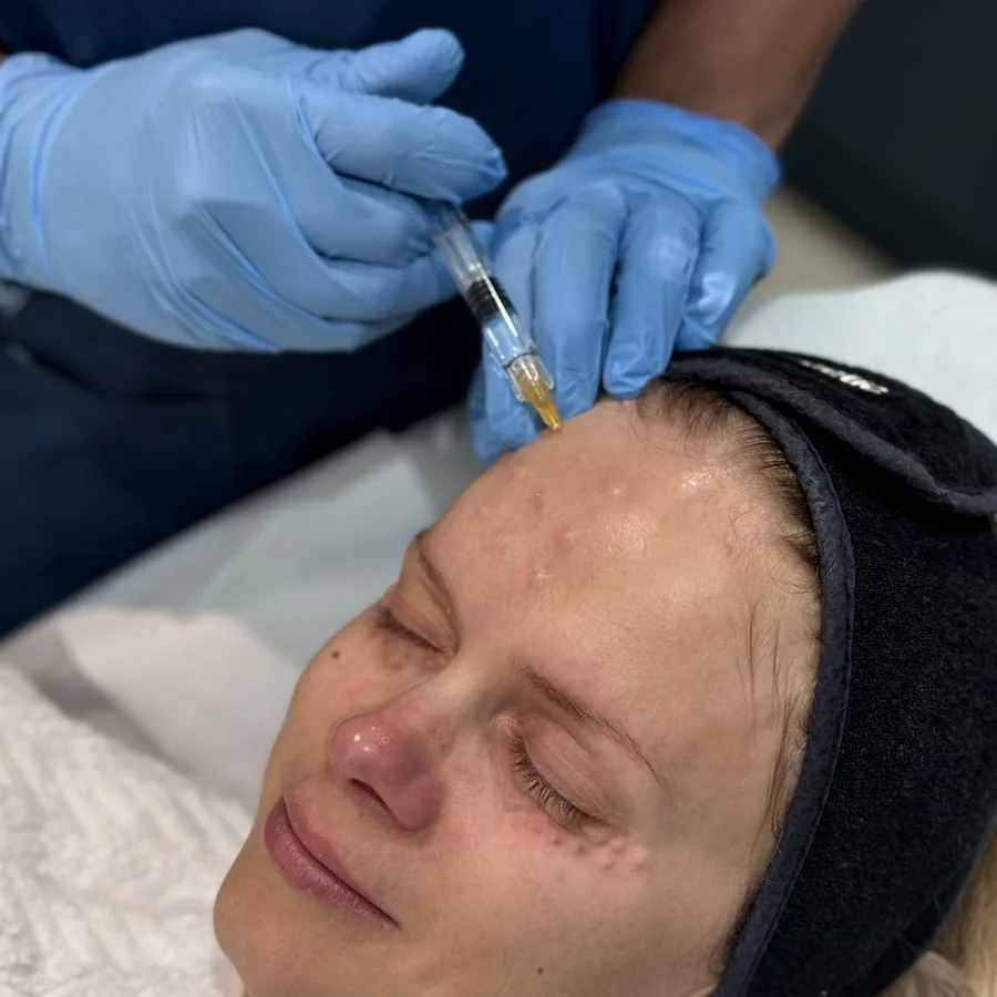 Skin-booster injection being placed on a patient’s forehead at Rejuvena Clinic in Bedford