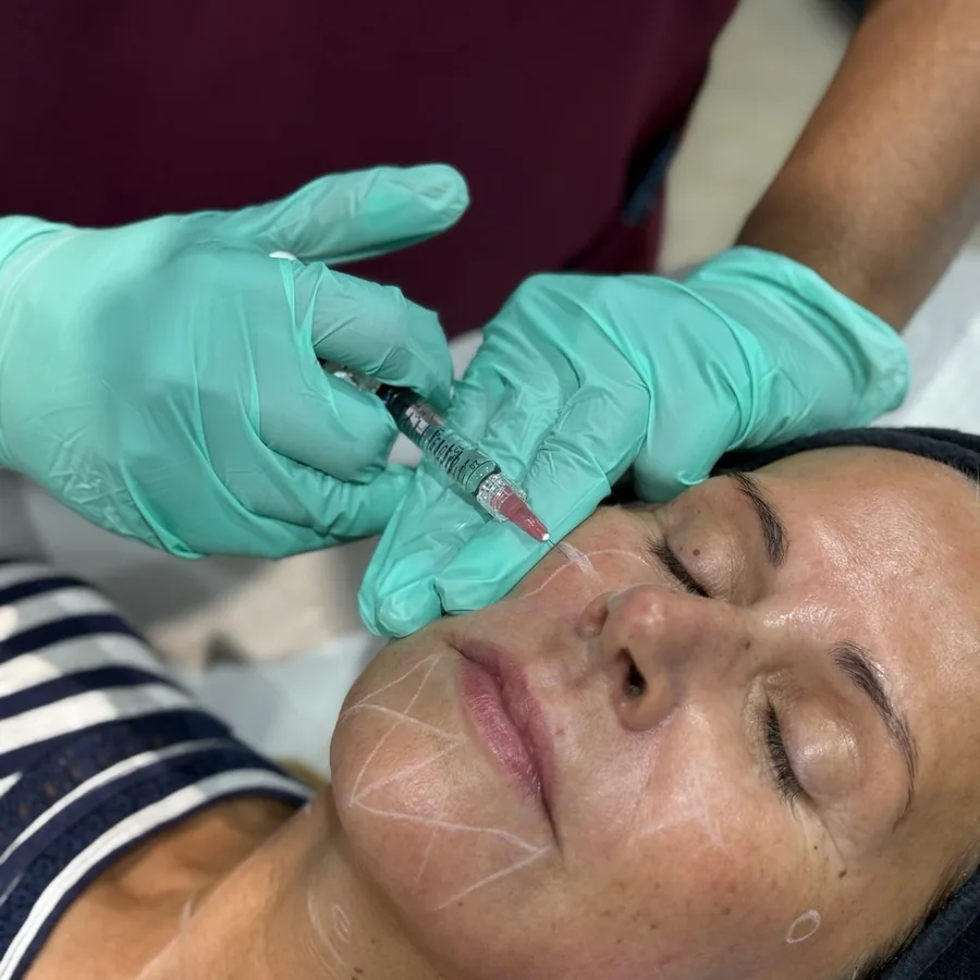 Profhilo injection being placed on a patient’s marked cheek at Rejuvena Clinic in Bedford
