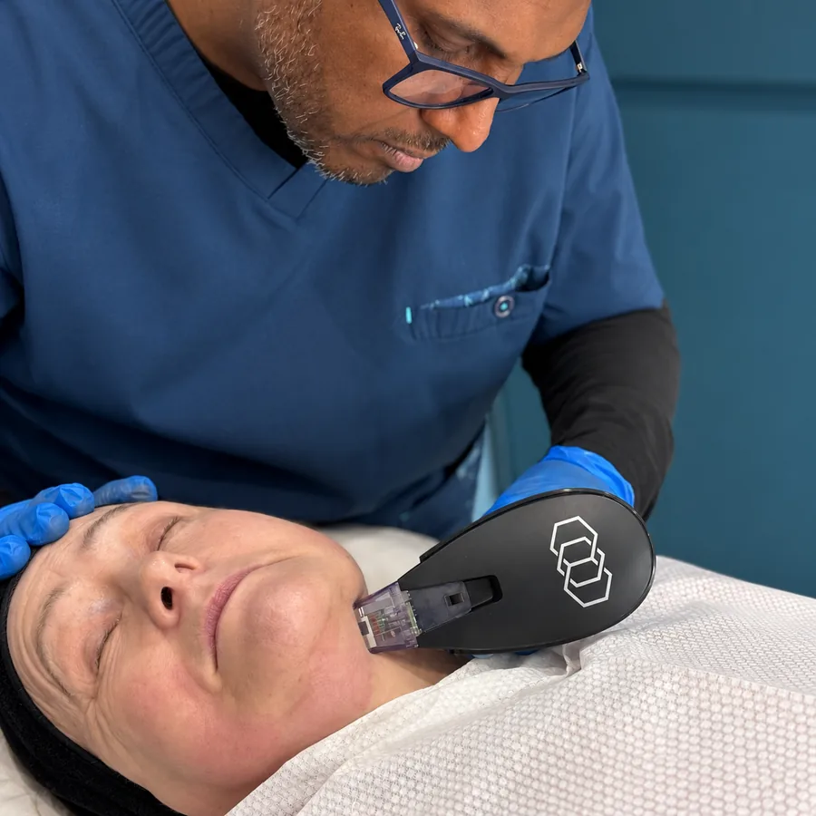 Dr Nick treating a patient’s temple with the Morpheus8 Burst RF microneedling handpiece at Rejuvena Clinic in Bedford