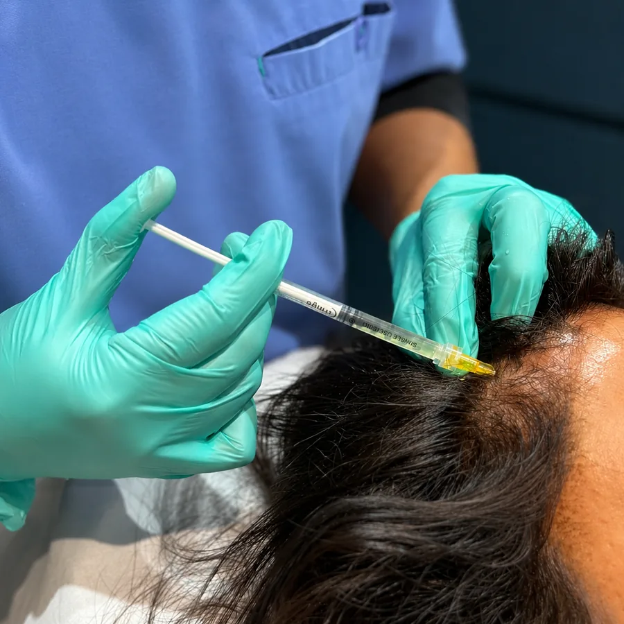PRP being injected into a patient’s scalp during hair loss treatment at Rejuvena Clinic in Bedford