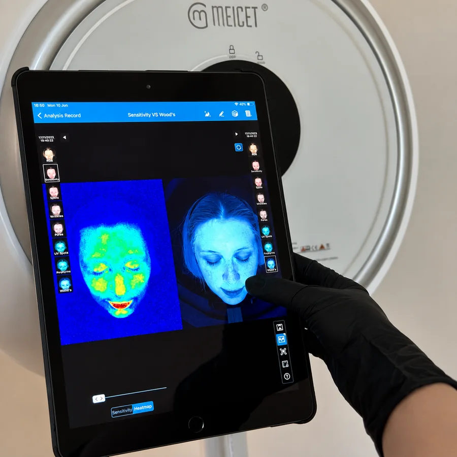 A skin analysis scan of a patient’s face shown on a tablet at Rejuvena Clinic, Bedford