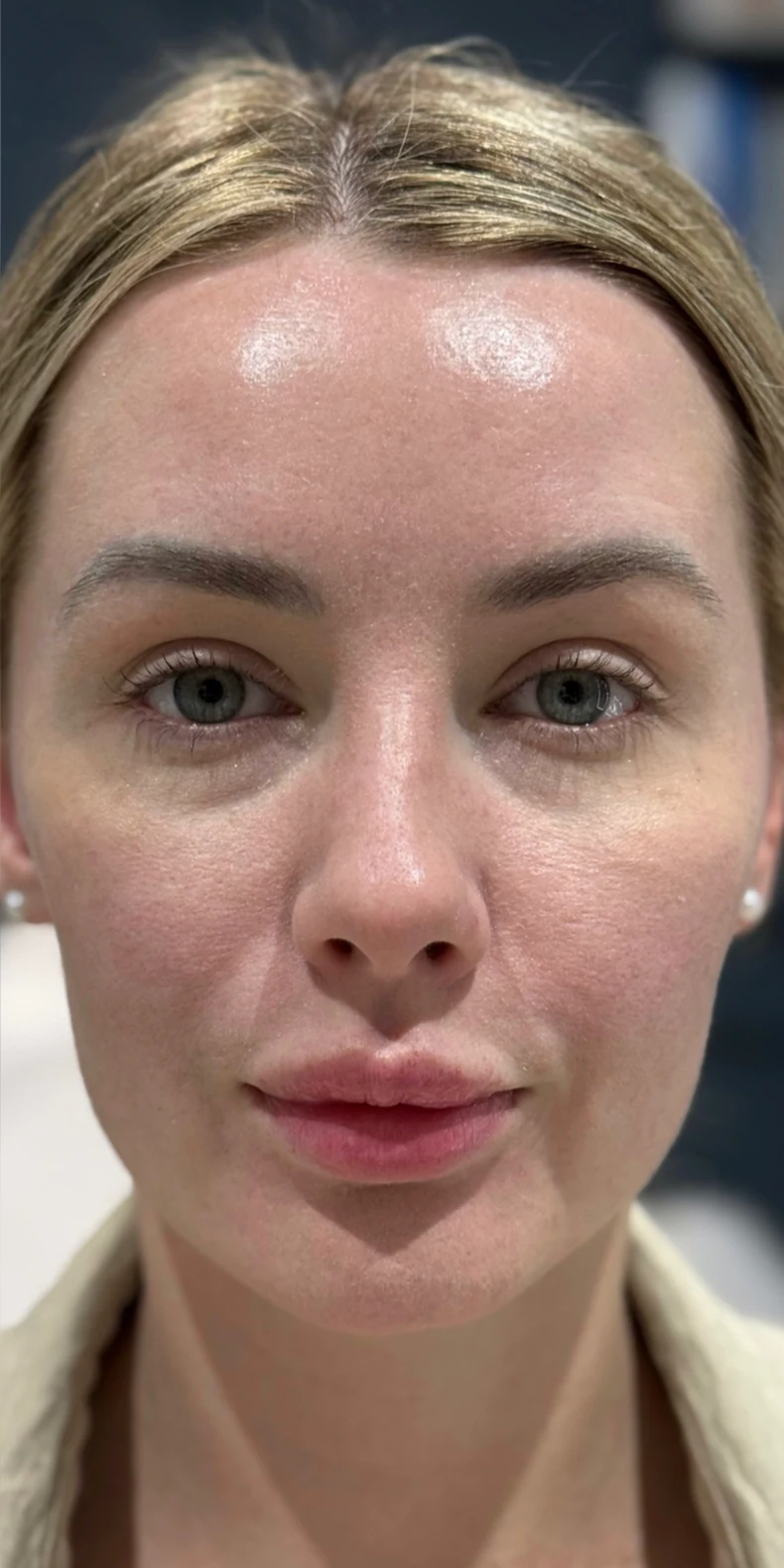 Uneven skin tone after — Lumecca IPL photofacial — Rejuvena Clinic Bedford