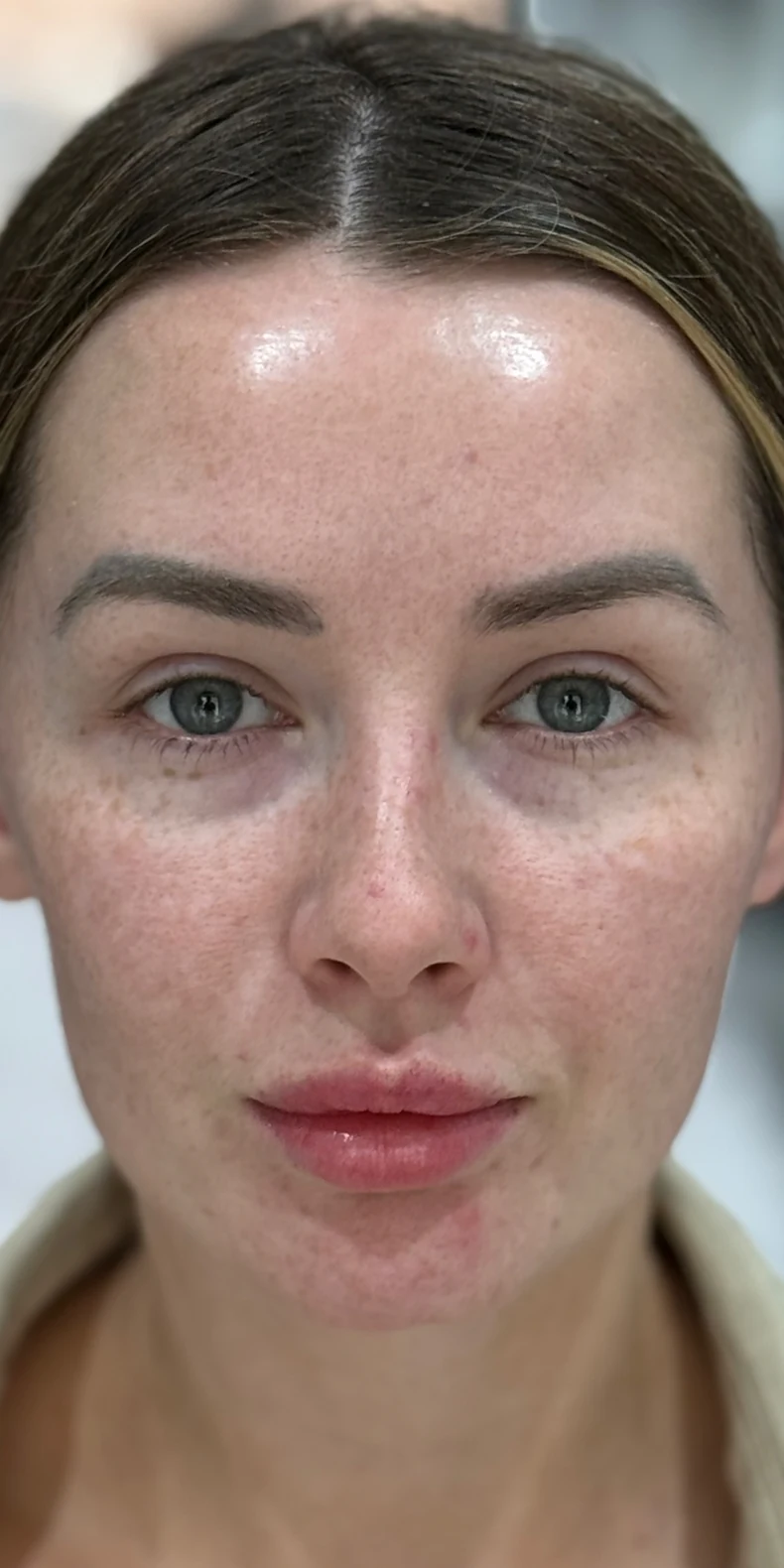 Uneven skin tone before — Lumecca IPL photofacial — Rejuvena Clinic Bedford
