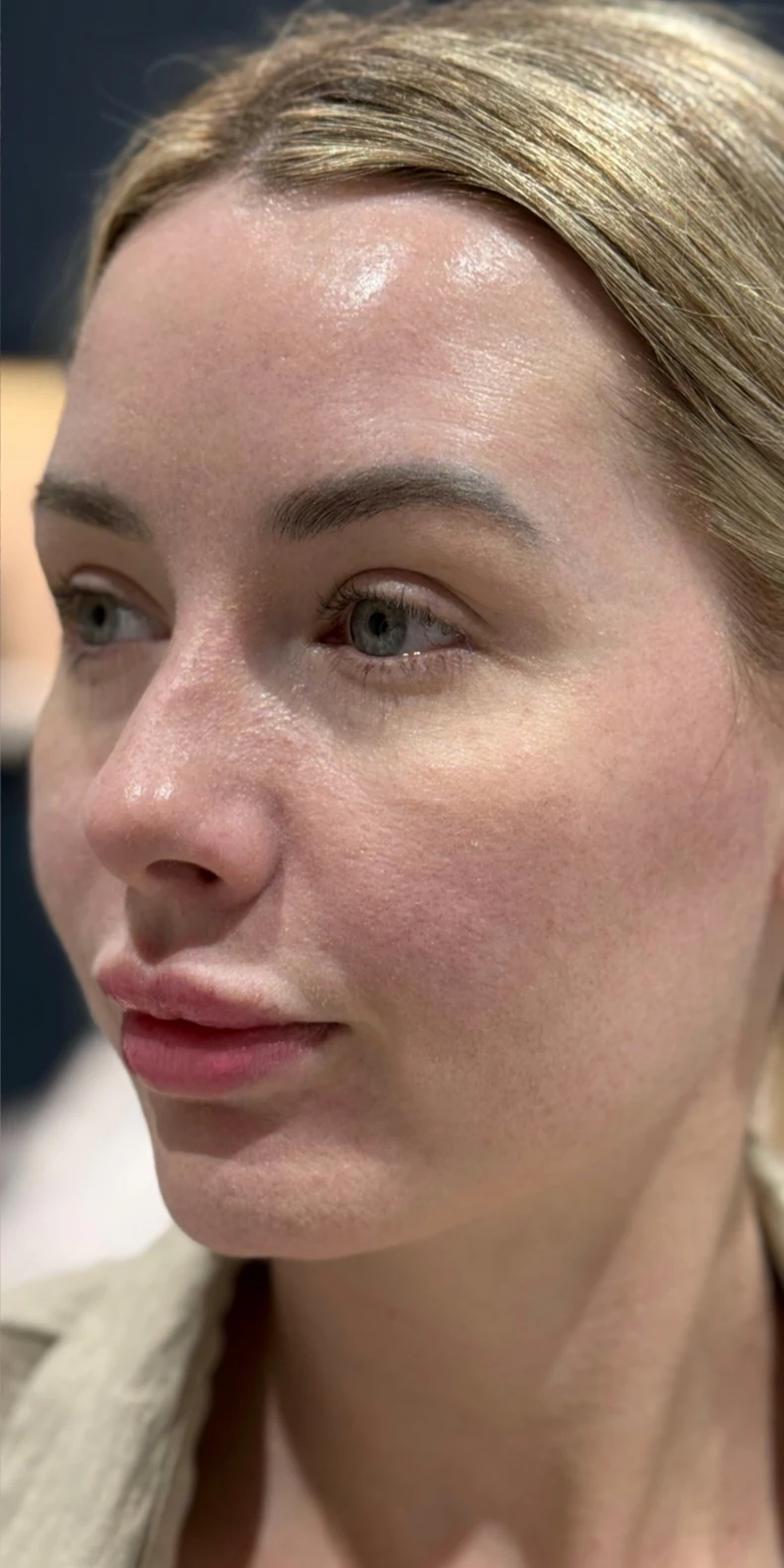 Pigmentation & redness after — Lumecca IPL photofacial — Rejuvena Clinic Bedford