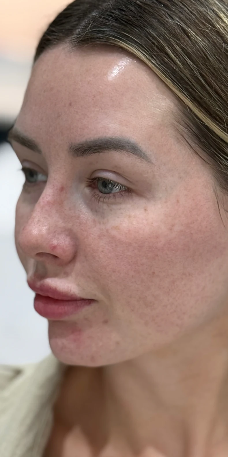 Pigmentation & redness before — Lumecca IPL photofacial — Rejuvena Clinic Bedford