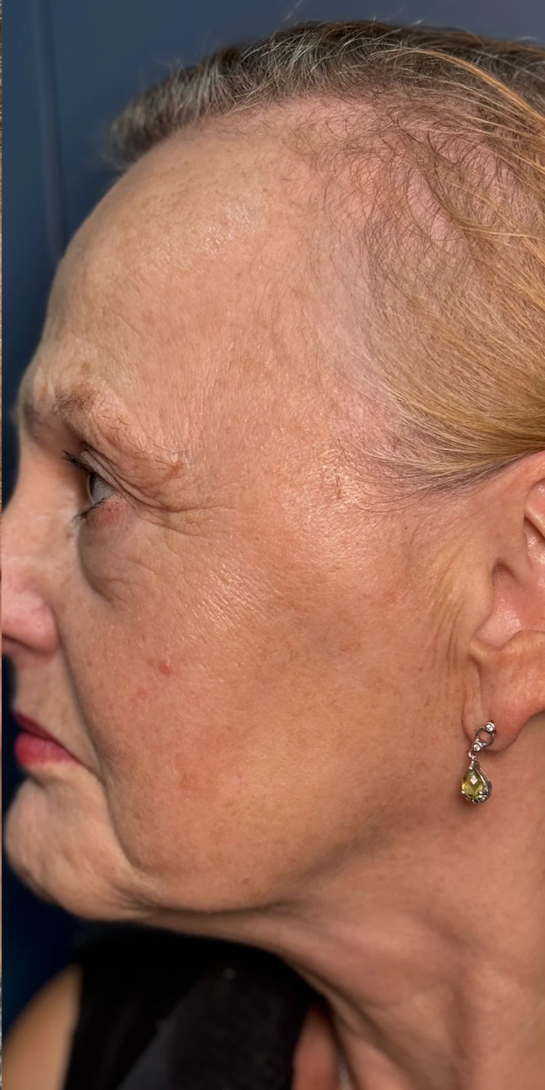 Age spots after — Lumecca IPL photofacial — Rejuvena Clinic Bedford