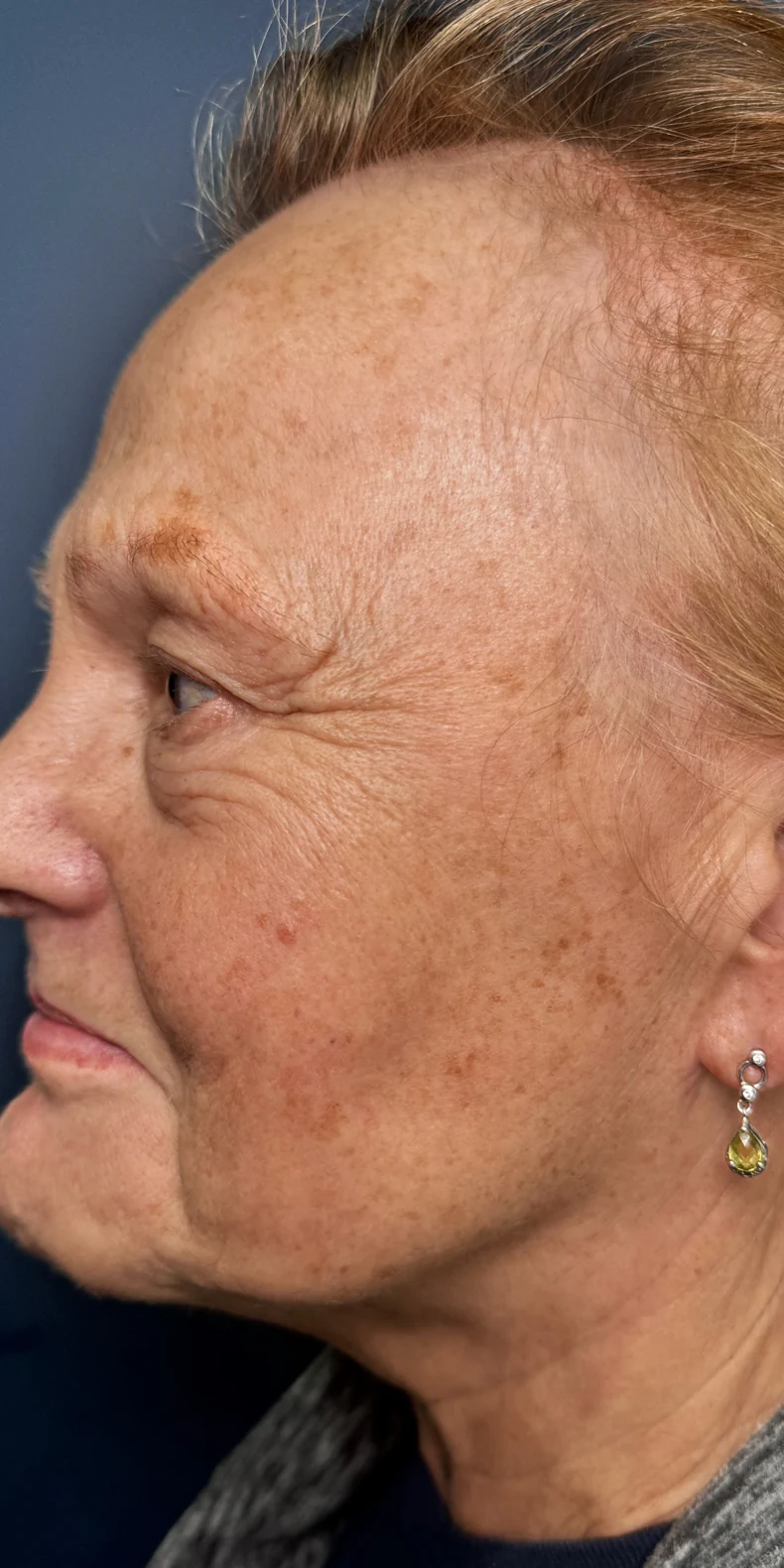 Age spots before — Lumecca IPL photofacial — Rejuvena Clinic Bedford