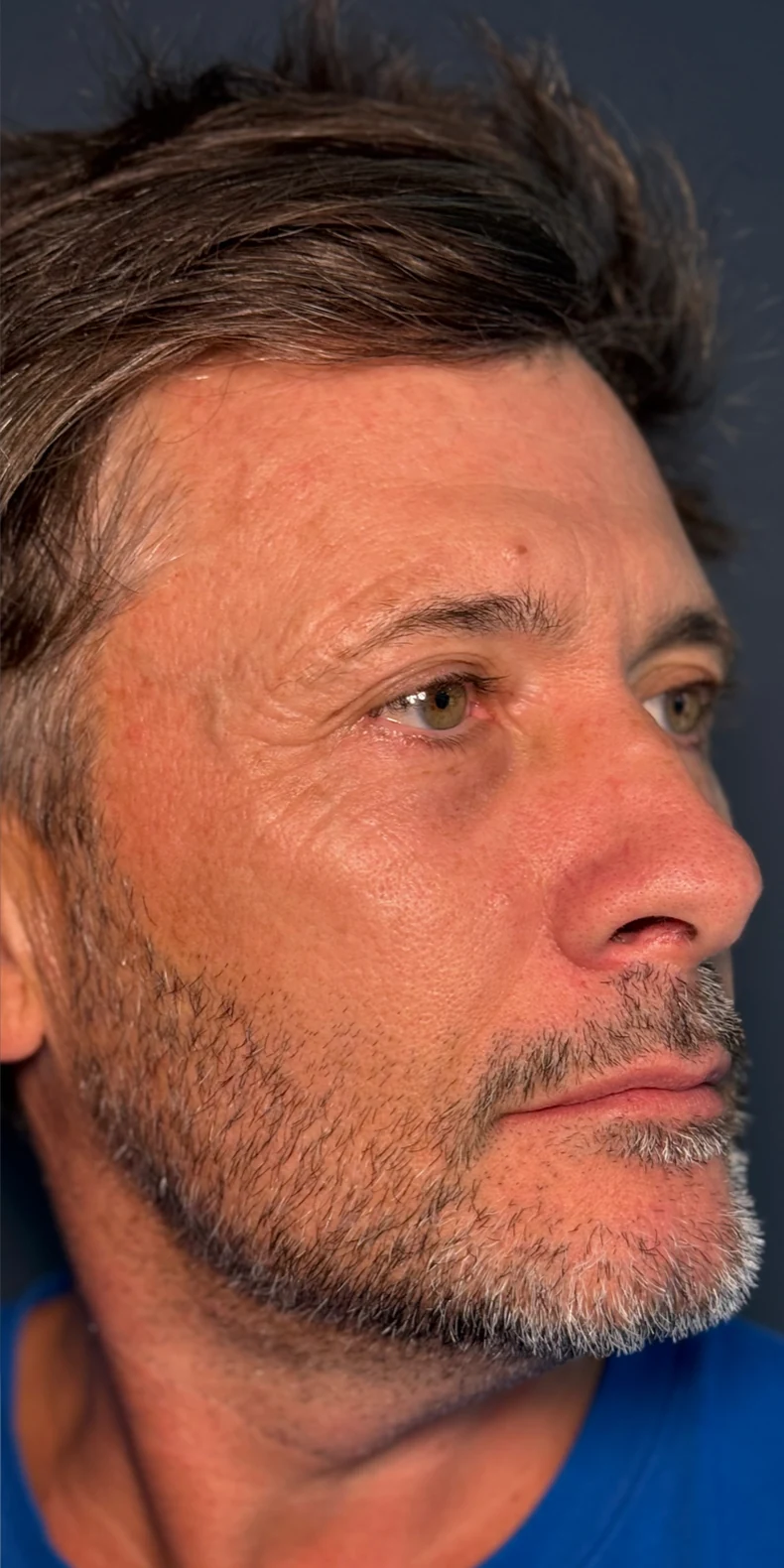Sun damage after — Lumecca IPL photofacial — Rejuvena Clinic Bedford