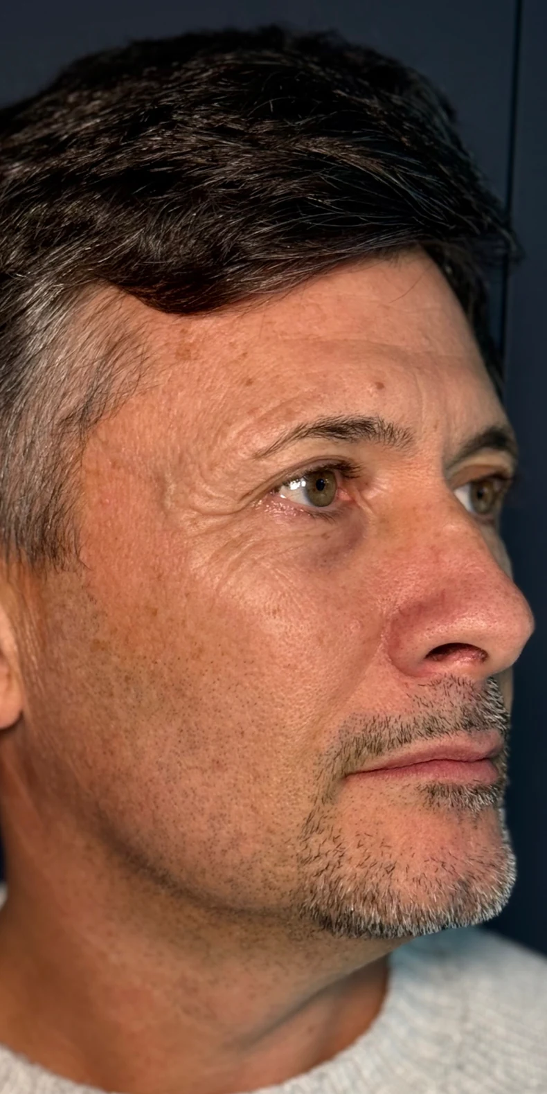 Sun damage before — Lumecca IPL photofacial — Rejuvena Clinic Bedford