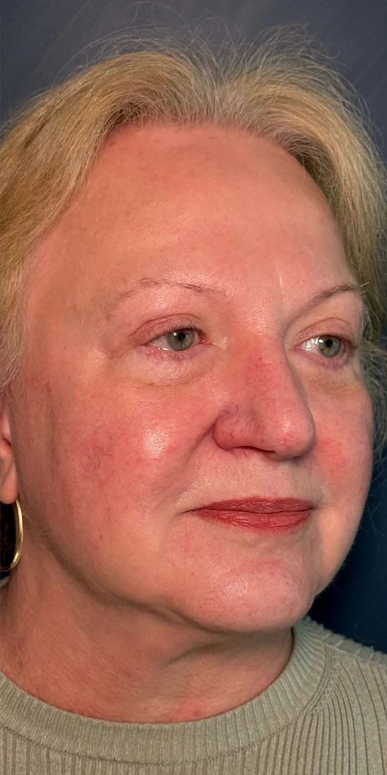 Facial redness after — Lumecca IPL photofacial (Lumecca IPL with Morpheus8 Burst) — Rejuvena Clinic Bedford