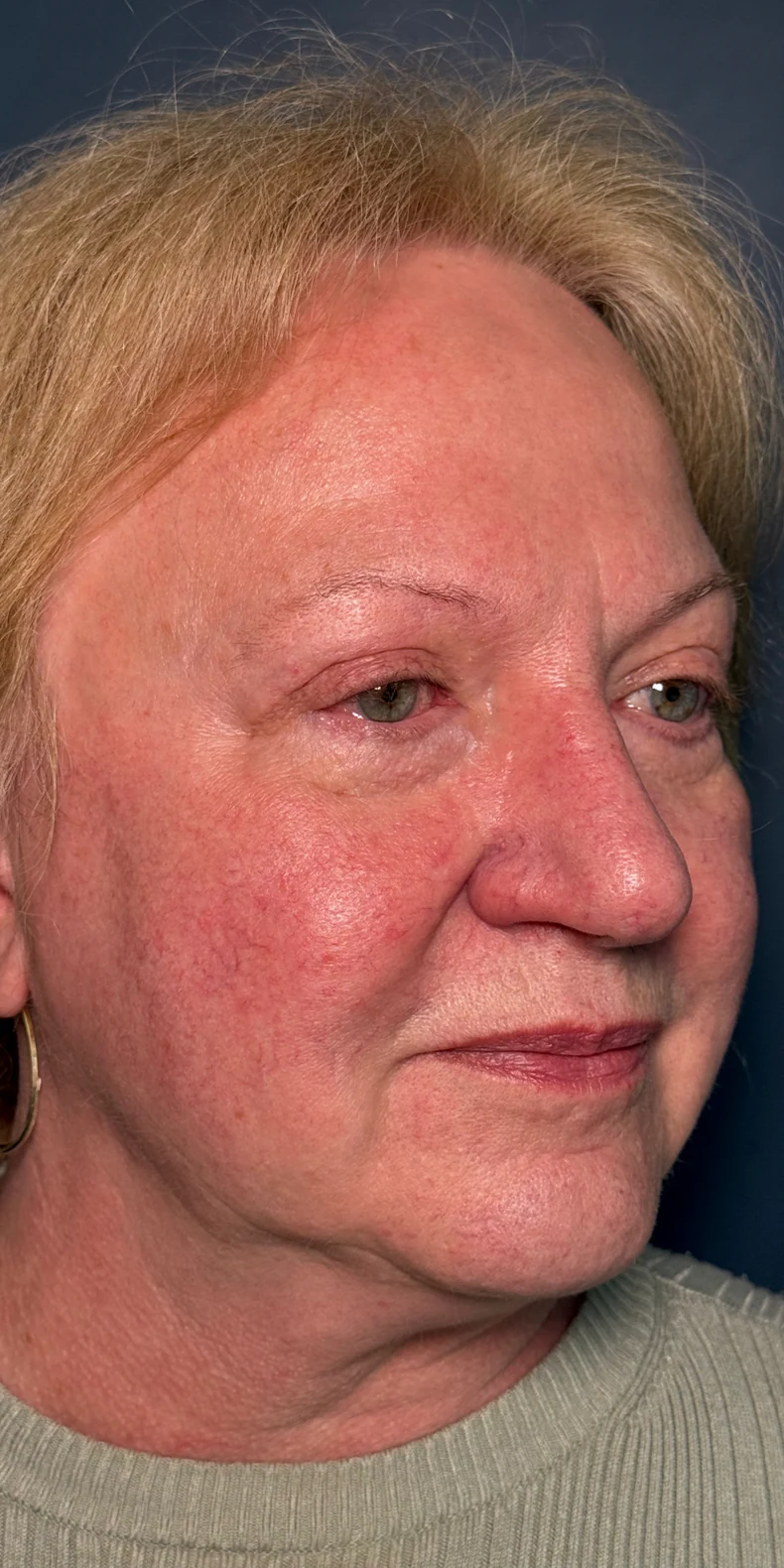 Facial redness before — Lumecca IPL photofacial (Lumecca IPL with Morpheus8 Burst) — Rejuvena Clinic Bedford
