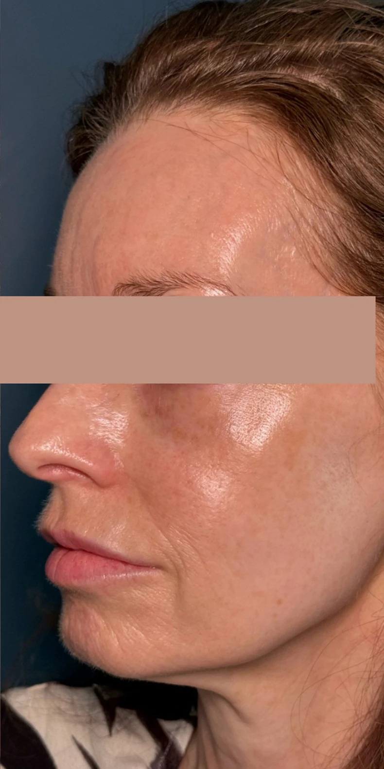 Facial pigmentation after — Lumecca IPL photofacial — Rejuvena Clinic Bedford