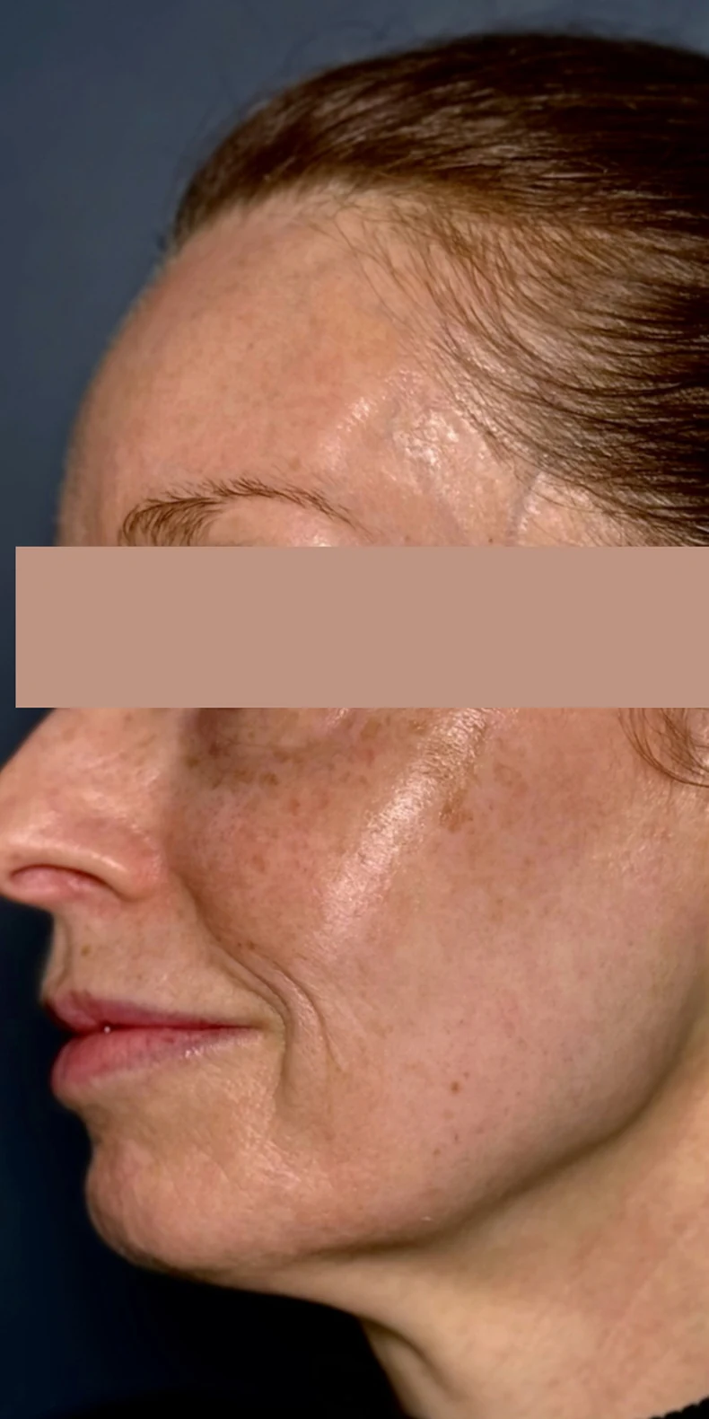 Facial pigmentation before — Lumecca IPL photofacial — Rejuvena Clinic Bedford