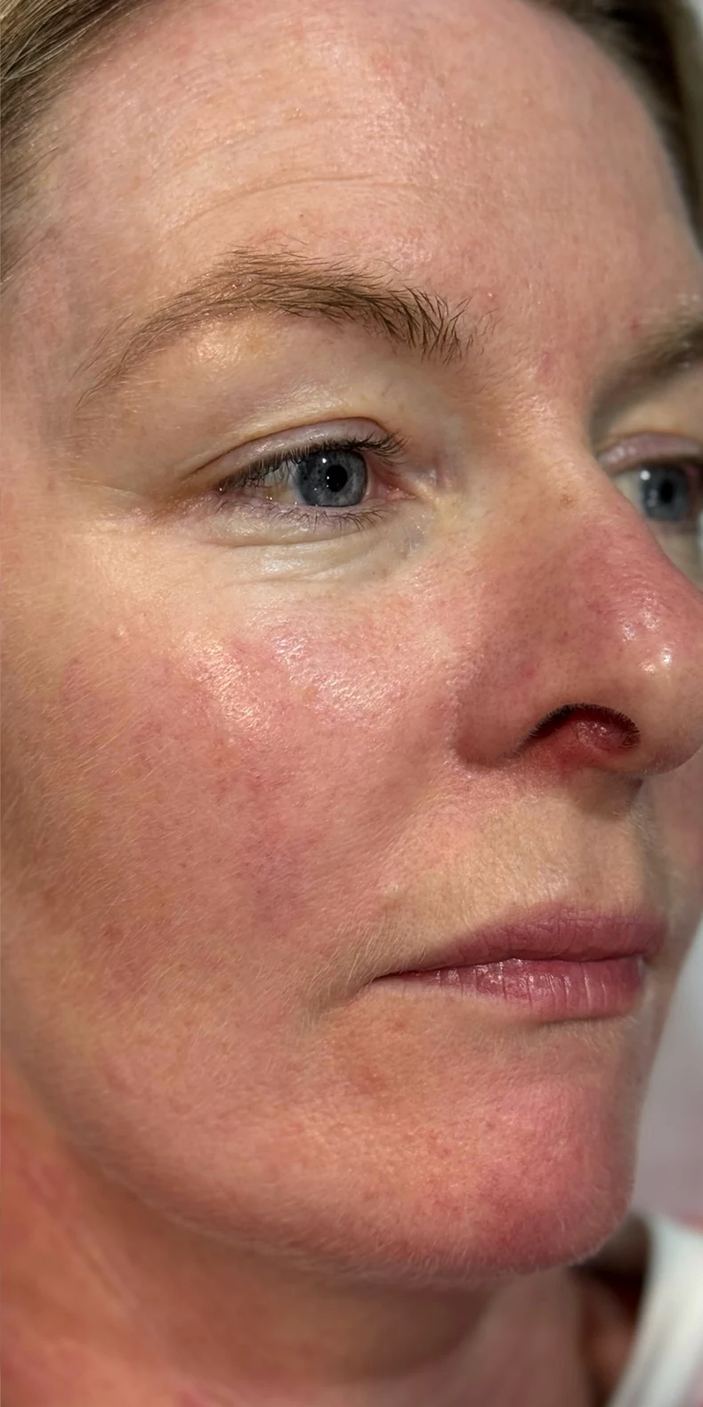 Rosacea & thread veins after — Lumecca IPL photofacial — Rejuvena Clinic Bedford