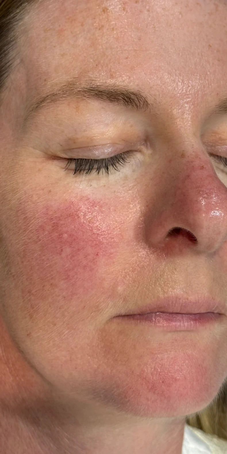 Rosacea & thread veins before — Lumecca IPL photofacial — Rejuvena Clinic Bedford