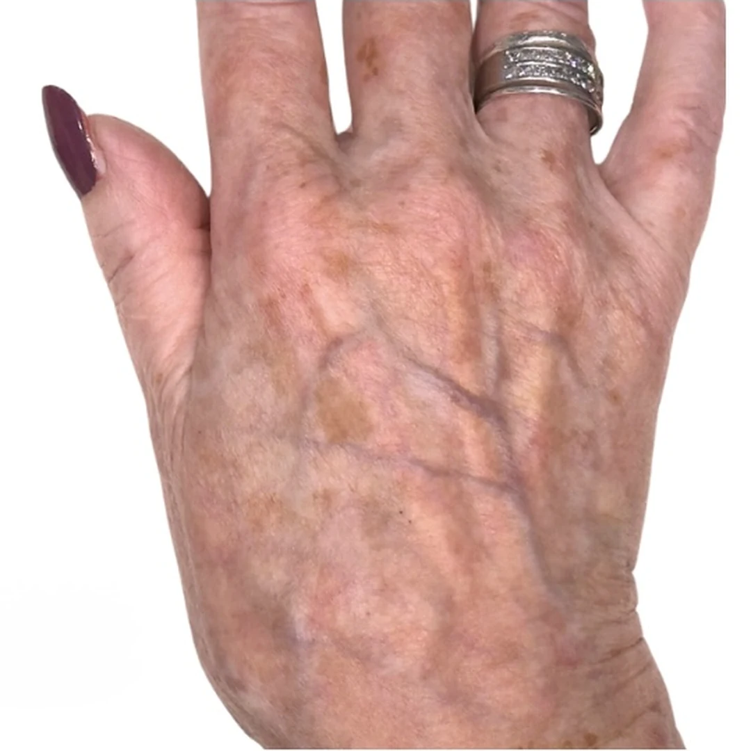 Sun damage on the hands after — Lumecca IPL photofacial — Rejuvena Clinic Bedford