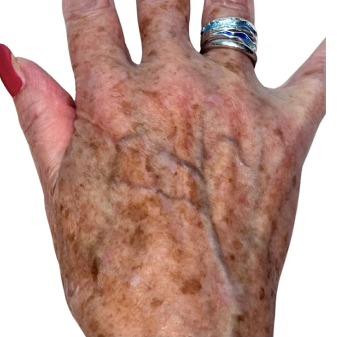 Sun damage on the hands before — Lumecca IPL photofacial — Rejuvena Clinic Bedford