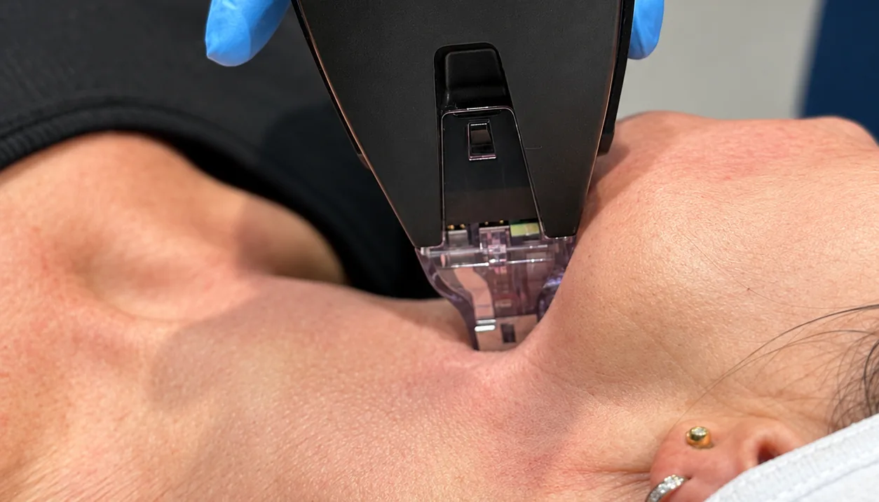 The Morpheus8 Burst handpiece treating the skin beneath the jawline at Rejuvena Clinic, Bedford