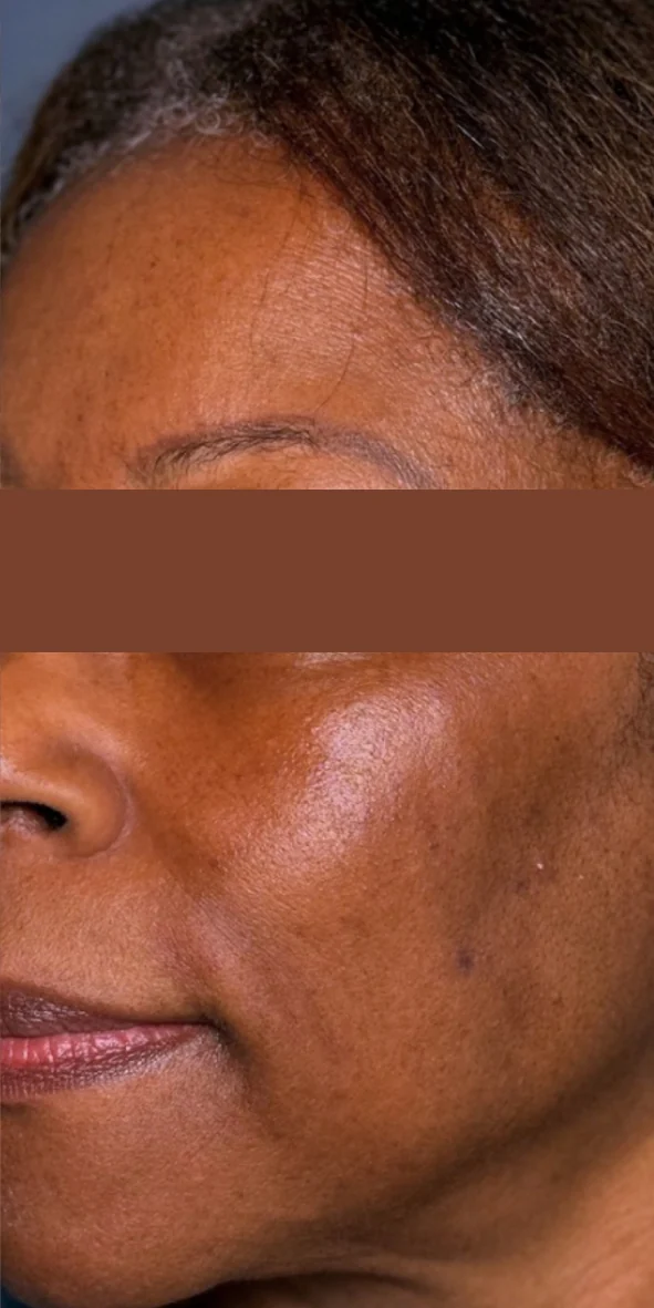 Cheek and temple after one Picofy pico laser session for pigmentation at Rejuvena Clinic, Bedford, with dark patches visibly lighter