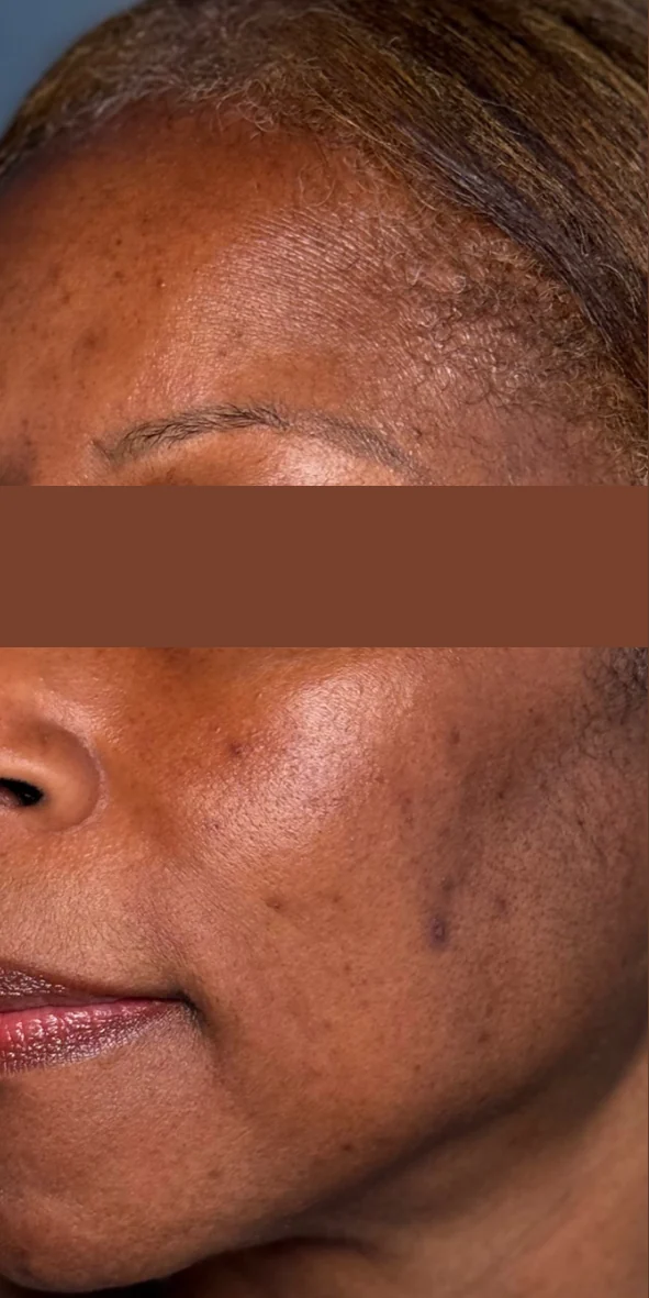 Cheek and temple with uneven dark pigmentation before Picofy pico laser treatment at Rejuvena Clinic, Bedford