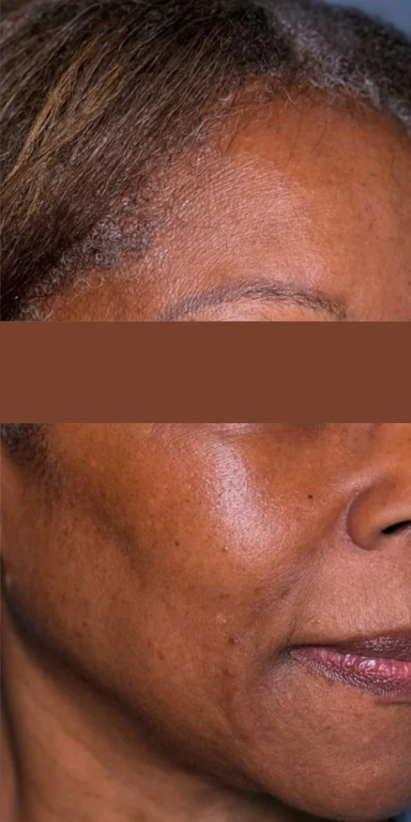 Cheek and temple after one Picofy pico laser session for pigmentation at Rejuvena Clinic, Bedford, with dark patches visibly lighter