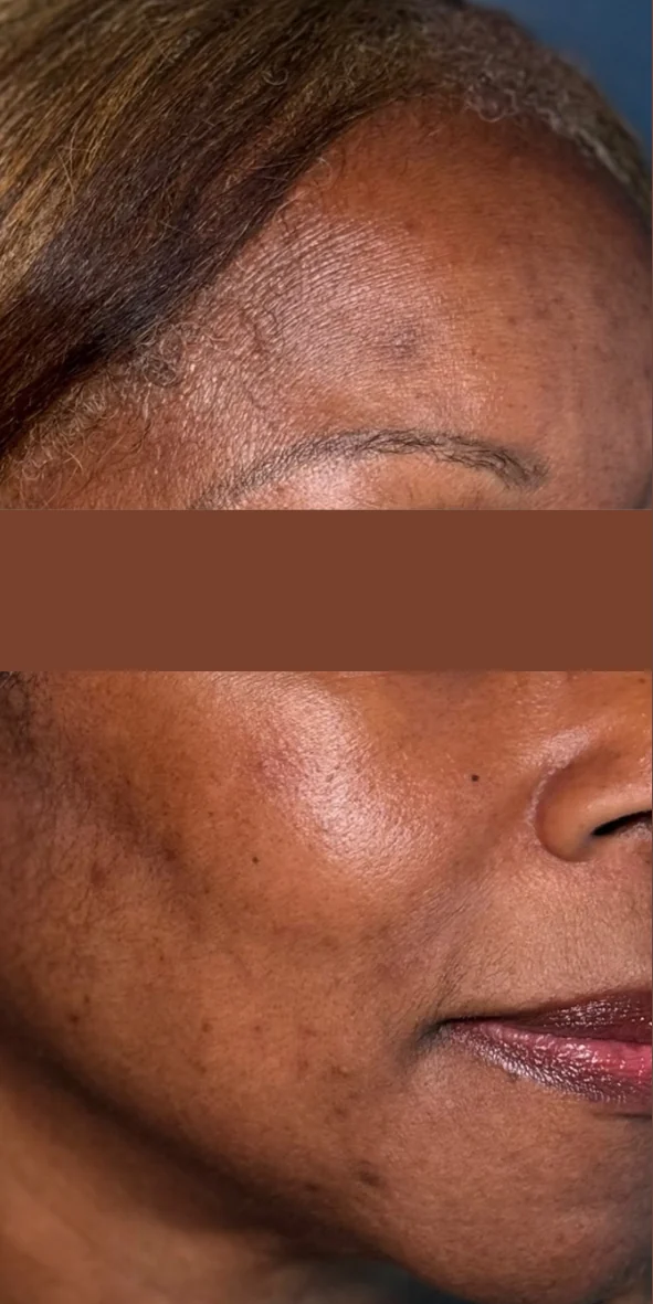 Cheek and temple with uneven dark pigmentation before Picofy pico laser treatment at Rejuvena Clinic, Bedford